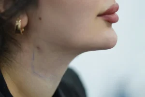 ساکشن غبغب