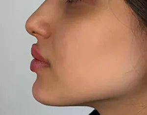 تزریق فیلر چانه در سنندج