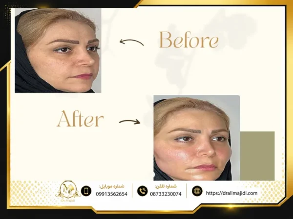 تزریق چربی