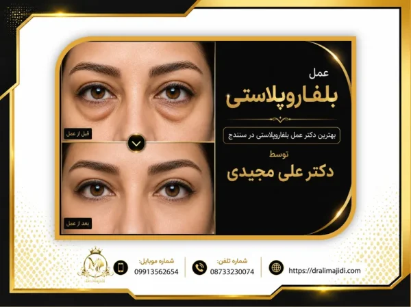 بهترین دکتر عمل بلفاروپلاستی در سنندج